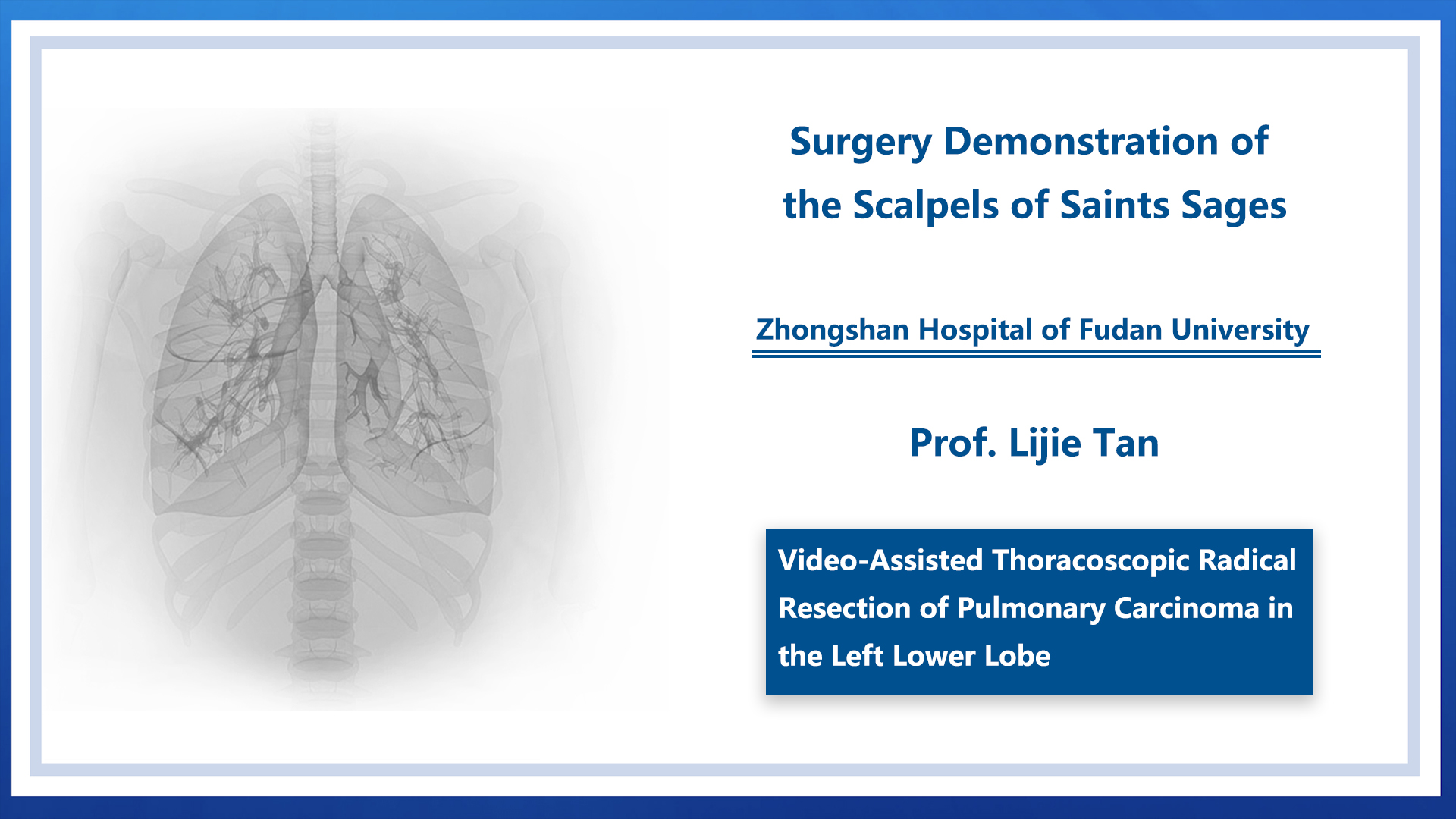 Video-Assisted Thoracoscopic Radical Resection of Pulmonary Carcinoma in the Left Lower Lobe