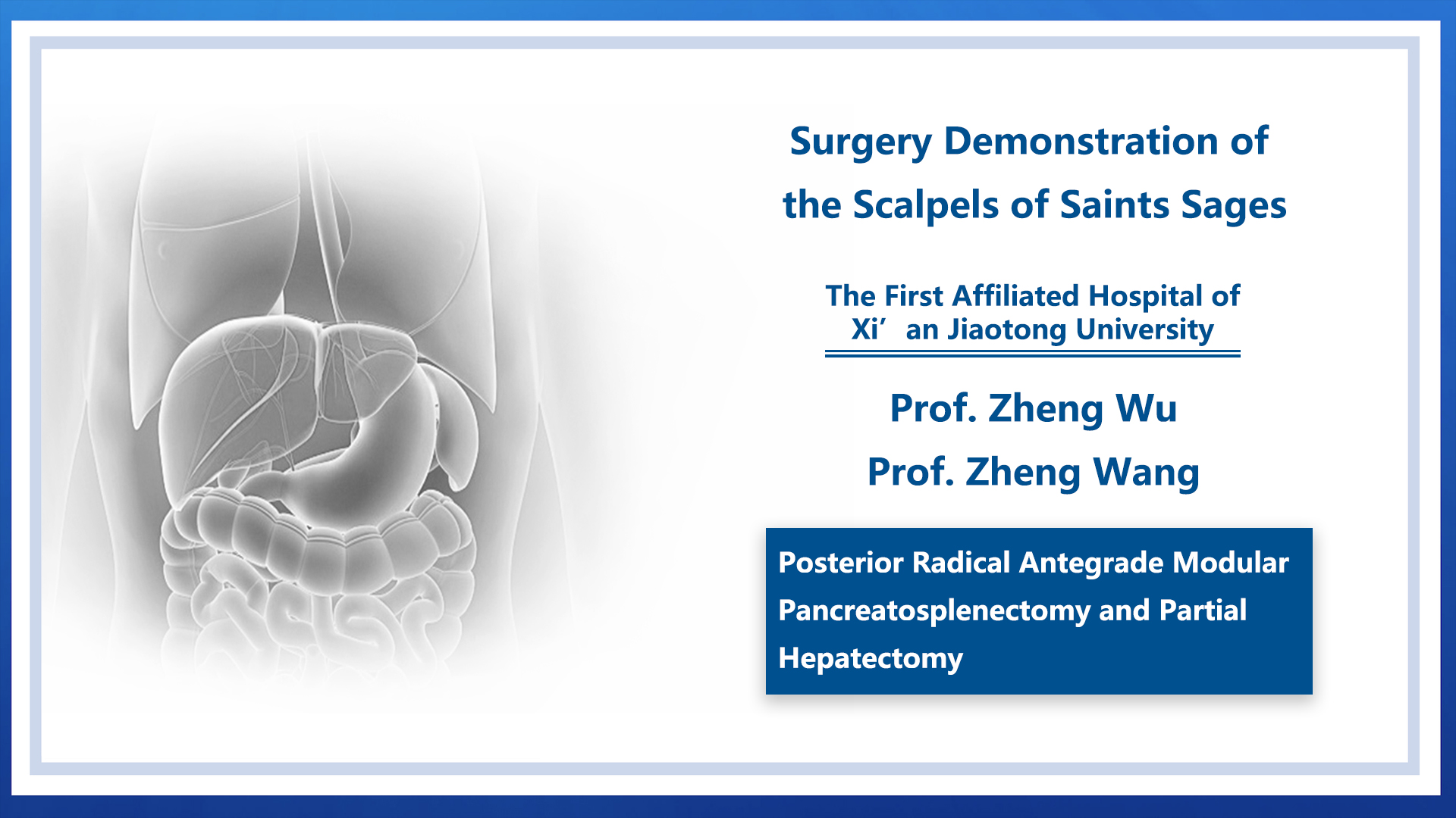 Posterior Radical Antegrade Modular Pancreatosplenectomy and Partial Hepatectomy
